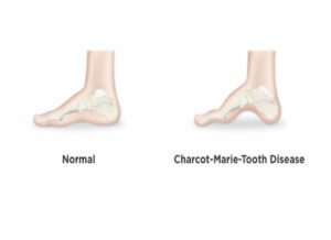 Charcot Marie tooth Disease (CMT)
